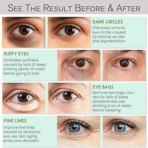 Under Eye Patches for Dark Circles and Puffiness - Under Eye Masks Anti-Aging Collagen Hyaluronic Acid, Reduce Dark Circles & Wrinkles Skincare Be...