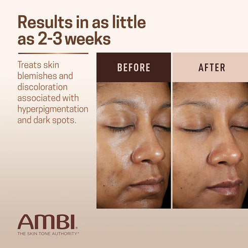 Ambi Even & Clear Fade Cream, Hydroquinone-free, Hyperpigmentation Treatment, Dark Spot Corrector, Results In As Little As 4 Weeks, Niacinamide, A...
