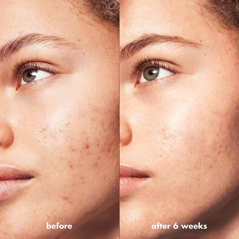 e.l.f. SKIN Blemish Breakthrough Clarifying Cleanser, Gel Cleanser For Removing Makeup, Controlling Oil & Clarifying Pores, 1% Salicylic Acid...