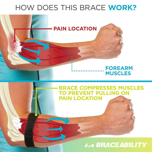 BraceAbility Epicondylitis Brace | Elbow Strap for Medial/Lateral Epicondyle Pain and Tendonitis Arm Compression Support Band for Men or Women (On...