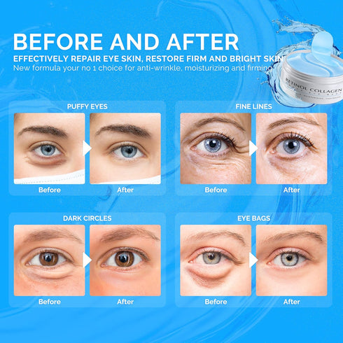 Enaskin Naturals Under Eye Patches for Dark Circles: 30 Pairs Retinol Collagen Eye Gels Mask - Reduce Wrinkles Puffy & Bags - Skin Treatment Pads ...