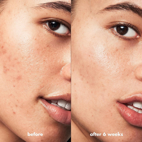 e.l.f. SKIN Blemish Breakthrough Blemish Control Basics Kit, Travel-Size Acne Skincare Routine, Cleanser, Serum & Moisturizer, Vegan & Cruelty-Fre...