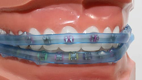 Element Braces Comfort Lip Bumper (Blue) - Orthodontic - Dental