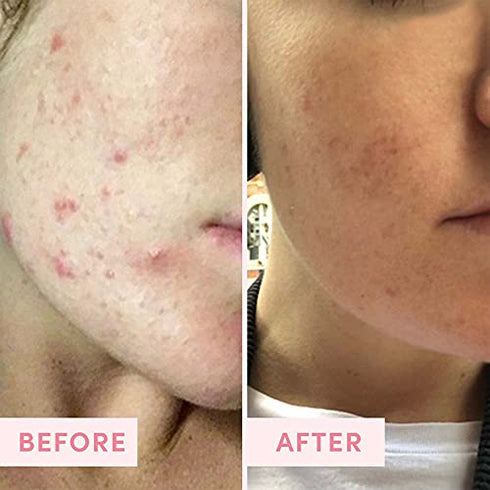 Sand & Sky Australian Pink Clay Face Mask - Travel Size Pore Mask & Facial Mask Skin Care Set | Limited Edition Pore Minimizer Face Mask Set.