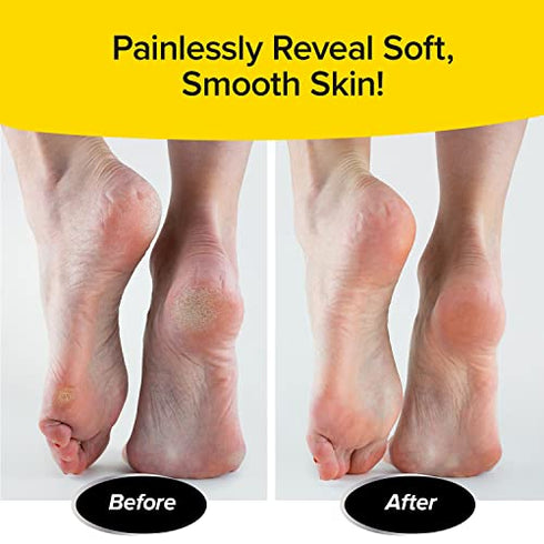 Ped Egg Classic Callus Remover, As Seen On TV, New Look, Safely and Painlessly Remove Tough Calluses & Dry Skin to Reveal Smooth Soft Feet, 135 Precision Micro-Blades, Traps Shavings Mess-Free