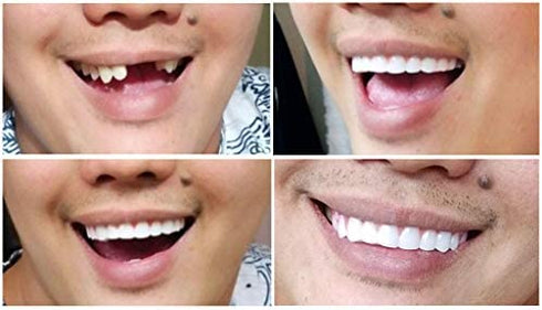 Instant Smile Comfort Fit Flex - Bright White - Upper Veneer Cosmetic Teeth