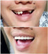 Instant Smile Comfort Fit Flex - Natural Shade - Upper Veneer Cosmetic Teeth