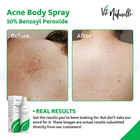 Face, Body Acne Spray with Benzoyl Peroxide - Salicylic Acid - Butt, Back Acne Treatment - Cystic Hormonal Acne Treatment, Body, Chest Spray with Tea Tree Oil - for Men, Women, Teens - Acne Body Spray
