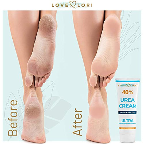 LOVE, LORI Urea Cream 40 Percent for Feet 4 oz Foot Cream For Dry Cracked Feet - Callus Remover & Foot Repair Treatment - Moisturizes Heels, Hands, Knees & Elbows - For Thick, Rough & Dry Skin