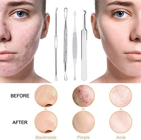 Black Head Remover Pimple Popper Tool Kit 10 Pcs, Comedone Pimple Extractor Tool, Acne Kit for Blackhead, Whitehead Popping, Zit Removing(Silver)
