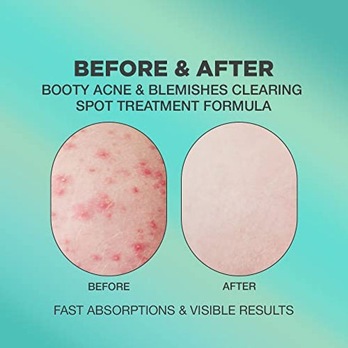 Butt Acne Clearing Spot Cream. Helps Clearing Acne, Cellulite, Ingrown Hairs, Blackheads, Zits, Razor Bumps and Dark Spots for the Buttocks and Thigh Area. Prevents Future Breakouts.