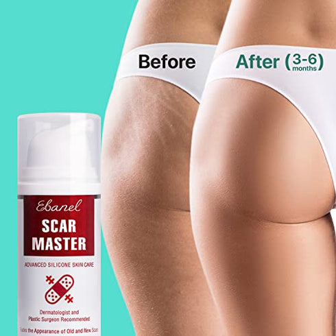 Ebanel Silicone Scar Gel with Onion Extract, Emu Oil, Vitamin E, Medical-Grade Scar Removal Cream for Old & New Acne Scars, Burn Scars, Surgical Scars, Injuries, Stretch Marks, C-Section, Insect Bites