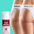 Ebanel Silicone Scar Gel with Onion Extract, Emu Oil, Vitamin E, Medical-Grade Scar Removal Cream for Old & New Acne Scars, Burn Scars, Surgical Scars, Injuries, Stretch Marks, C-Section, Insect Bites