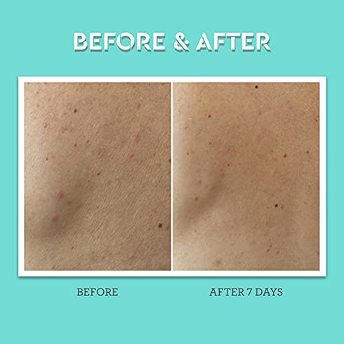 Bliss Clear Genius Body Acne Spray | Maximum Strength 2% Salicylic Acid Shrinks & Prevents Body Acne | Clean | Cruelty-Free | Paraben Free | Vegan | 3.5 oz