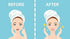 Acne Patch | Absorbing Hydrocolloid Acne Dots | Promotes Clear Skin | Hydro-Band - 1 Pack of 36