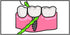 IDontix Brace X-Floss, Green