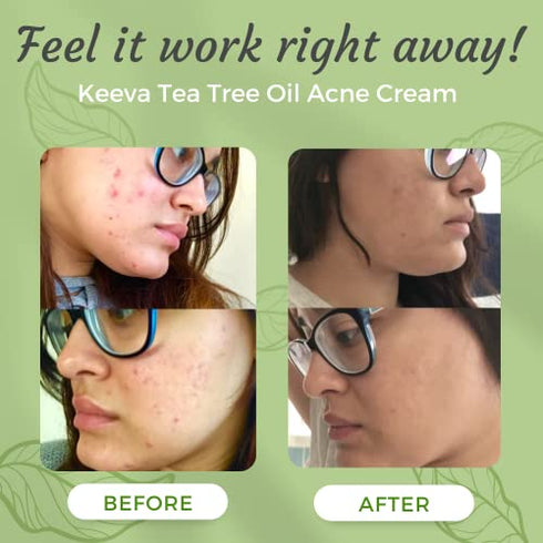 Acne Treatment Cream With Secret TEA TREE OIL Formula - Perfect For Fighting Breakouts, Spots, Cystic Acne, Acne Scar Removal - See Results in Days Without Dry Skin - by Keeva Organics (1oz)