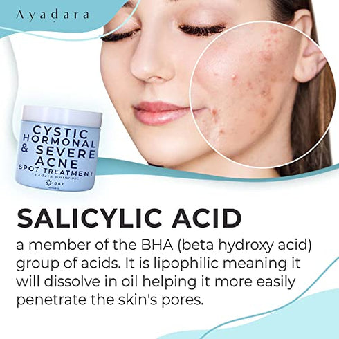AYADARA Cystic, Hormonal & Severe Acne Spot Treatment, Natural Pimple Cream with Salicylic Acid & Tea Tree for Teens & Adults, Zit, Milia, & Blemish Minimizer for a Clean Face & Body, 150+ Treatments