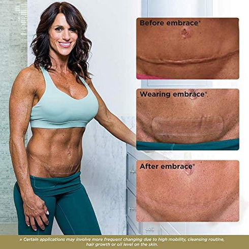 Embrace Active Scar Defense for New Scars, FDA-Cleared Silicone Scar Sheets, 6.3 Inch, X-Large, 30 Day Supply
