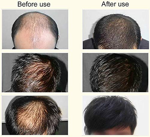 2 PCS 7X Rapid Growth Hair Treatment 7 Day Hair Growth Serum Essence Oil Regrow, with Natural Vitamin Rich Treatm, for Fuller Healthier Hair, Prevent Hair Loss and Thinn