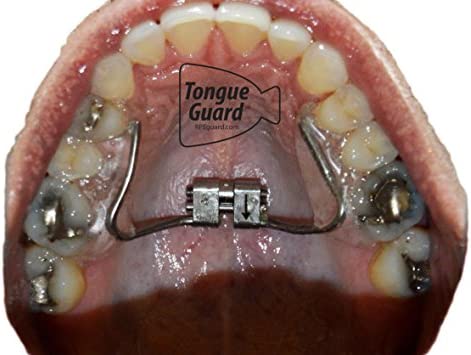 RPE Tongue Guard: Prevents and Helps Heal Tongue Sores Caused by Dental Expanders