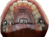 RPE Tongue Guard: Prevents and Helps Heal Tongue Sores Caused by Dental Expanders