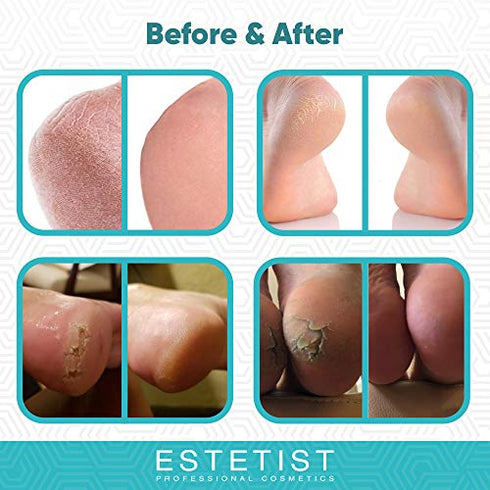 ESTETIST Urea Foot Cream 40%, Foot Lotion For Dry Cracked Feet, Moisturizer For Rough Heel, Foot Care Lotion with Vitamin E and Aloe Vera, Reduce Itching
