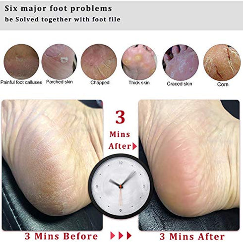 Kinepi Foot File Callus Remover Foot Scrubber,Professional Pedicure Foot Rasp Removes Cracked Heels,Dead Skin,Corn,Hard Skin,Pumice Stone for Feet Scraper File Brush Tools for Wet and Dry Feet