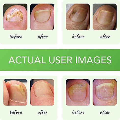 FUNGINIX Healthy Nail Formula - Finger and Toe Fungus Treatment, Made in USA, Eliminate Fungal Infections, Maximum Strength Solution (1 Fluid Ounce)