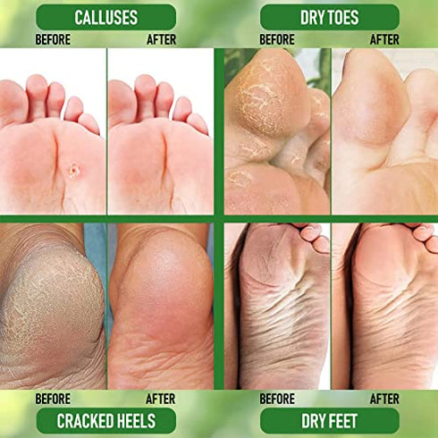 PurOrganica Urea 40% Foot Cream - No Pumice Stone - Callus Remover - Moisturizes & Rehydrates Thick, Cracked, Rough, Dead & Dry Skin - For Feet, Elbows and Hands - Made in USA
