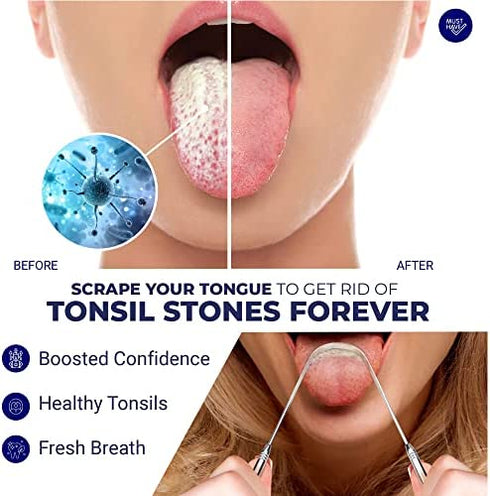 ORAVIX Tonsil Stone Remover | Tonsil Stone Removal Kit | Tonsil Stone Treatment | Tonsil Stone Removal | Tonsil Cleaner | Three Tonsil Stone Removal Tools | Lighted Pick, Irrigator & Tongue Scraper