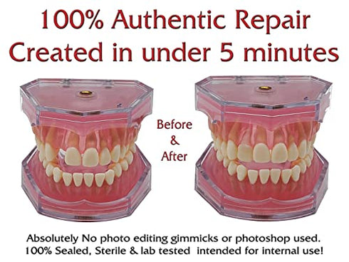 SmileFix Standard Color Matching Dental Repair Kit – Replace Missing or broken tooth. Gaps, broken teeth space temporary quick & safe. Regain your confidence and beautiful smile in minutes at home!