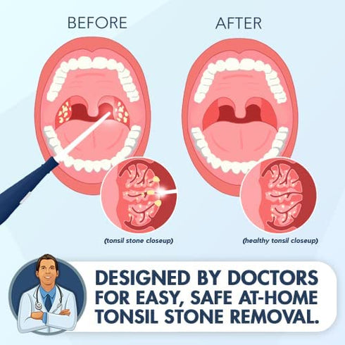 Dr. Frederick’s Original Easy Tonsil Stone Remover Kit - Fast Painless Tonsillolith Removal Tool - Fight Bad Breath - Pick and Oral Irrigator - 8 Pieces