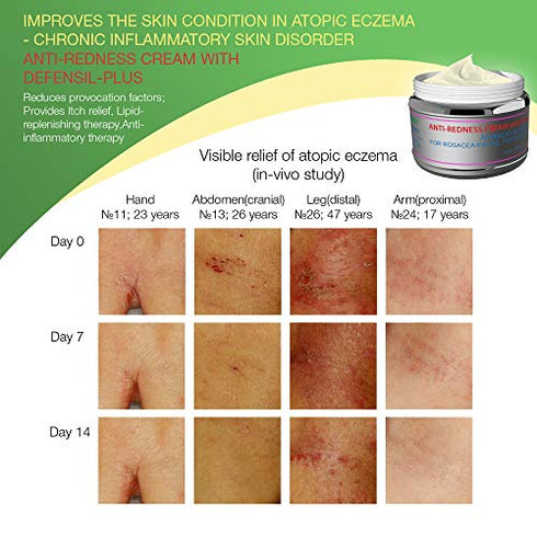 Redness Relief Face Eczema Cream - All-Natural Anti Itch Cream - Fast-acting Rosacea Treatment for Face - Facial Moisturizer and Eczema Treatment Body Cream - Hormone-Free Rosacea Skin Care Products