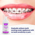 OrthoFoam Braces Cleaner - Cleans Under Metal, Ceramic or Clear Brackets & Wires. Can Brush or Rinse With & Use in Trays. Foaming Bubbles Whiten Teeth & Fight Plaque (1 Pack - 25 ml)