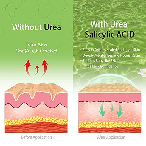 Vebuni Urea Cream 42% Foot Cream Salicylic Acid 4 Oz, Upgraded Callus Remover For Feet, Knees& Elbows, Intensive Moisturizes & Softens Skin, Exfoliates Dead Skin