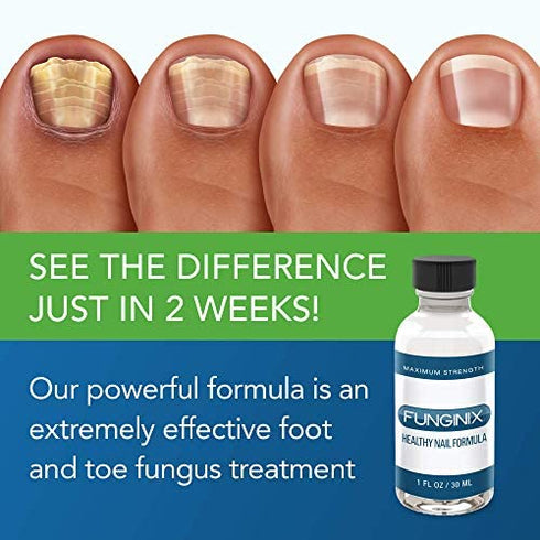 FUNGINIX Healthy Nail Formula - Finger and Toe Fungus Treatment, Made in USA, Eliminate Fungal Infections, Maximum Strength Solution (1 Fluid Ounce)