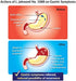 GASTRICELL - Eliminate H. Pylori, Relieve Acid Reflux and Heartburn, Regulate Gastric Acid - Targets The Root Cause of Recurring Gastric Problems, Natural Defence Against Gastric Distress -30 sachets