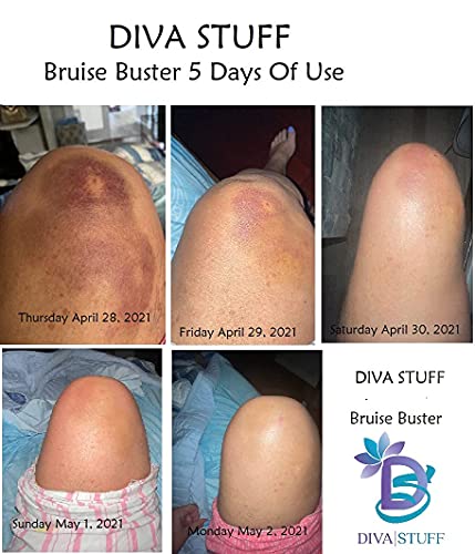 Diva Stuff Bruise Busting Treatment Cream, for Those Who Bruise Easily, with Arnica Butter, Lavender and Turmeric, All Natural, 4 oz