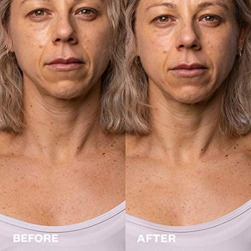 Wrinkles Schminkles Liquid Exfoliation Peel for Neck & Décolletage, Skin Exfoliating Resurfacing Pads, 5 Count (5x3ml)