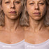 Wrinkles Schminkles Liquid Exfoliation Peel for Neck & Décolletage, Skin Exfoliating Resurfacing Pads, 5 Count (5x3ml)