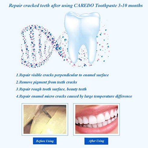 CAREDO Healing Teeth Crack Toothpaste, The ONLY Toothpaste Repairing Cracked Teeth Enamel Cracks, Cure Tooth Sensitivity, Root Damage Teeth Displacement Treatment, Remove Pigment in Crack 100g 1 Count