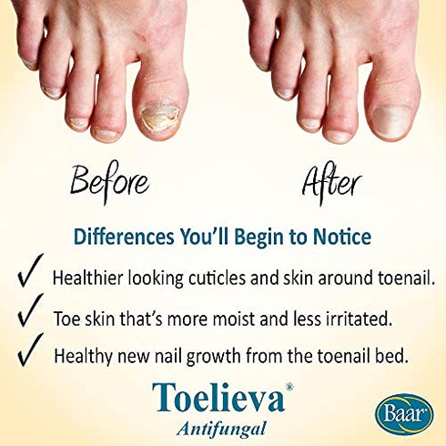 Baar Products - Toelieva Antifungal Liquid Solution - 25% Undecylenic Acid, Organic Olive Oil, Grapefruit Seed Extract - Maximum Strength - Fights Fungus Under & Around Toenails - 2 oz