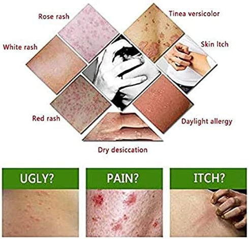 WEISPO 6PCS Lot Chinese Herbal Eczema, Psoriasis Creams Dermatitis and Eczema Pruritus Psoriasis CEZUBEM Ointment