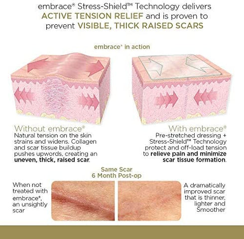Embrace Active Scar Defense for New Scars, FDA-Cleared Silicone Scar Sheets, 6.3 Inch, X-Large, 30 Day Supply
