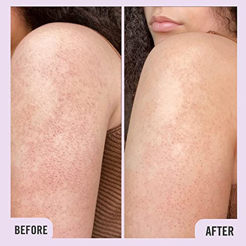 First Aid Beauty KP Bump Eraser Body Scrub Exfoliant for Keratosis Pilaris with 10% AHA 2 oz.