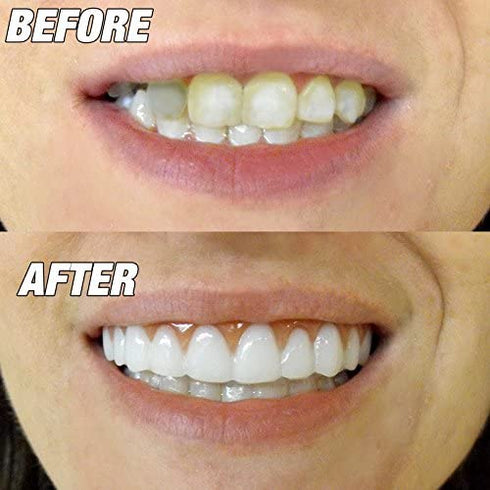 Instant Smile Comfort Fit Flex - Bright White - Upper Veneer Cosmetic Teeth
