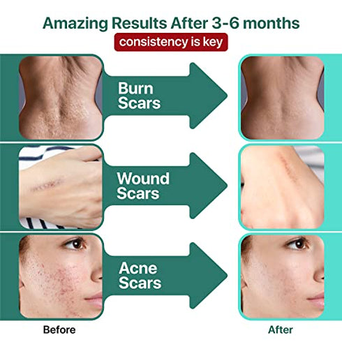 Ebanel Silicone Scar Gel with Onion Extract, Emu Oil, Vitamin E, Medical-Grade Scar Removal Cream for Old & New Acne Scars, Burn Scars, Surgical Scars, Injuries, Stretch Marks, C-Section, Insect Bites