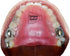RPE Tongue Guard: Prevents and Helps Heal Tongue Sores Caused by Dental Expanders