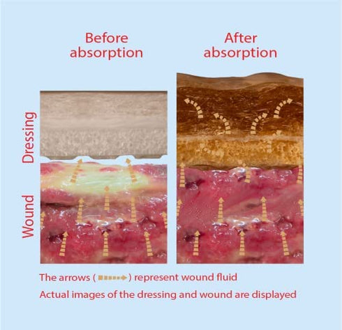 Ultra-Absorbent Silicone Foam Dressing with Border (Adhesive) Waterproof 4" X 4" (10 Cm X 10 Cm) (Central Ultra-Absorbent Foam 2.5" X 2.5") 10 Per Box (1) Wound Dressing by Areza Medical